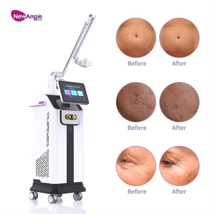 Laser Skin Resurfacing Device